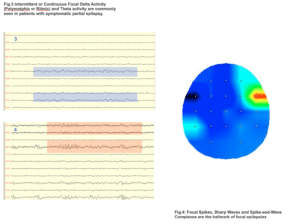EEG con mappa focale