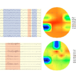 EEG con mappa generalizzato