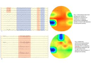 EEG con mappa generalizzato